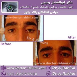 جرایح افتادگی پلک