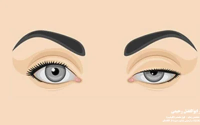 علت افتادگی پلک; دلایل افتادگی پلک بالا و پایین