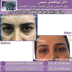 جراحی زیبایی پف پلک