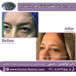 جراحی زیبایی پلک