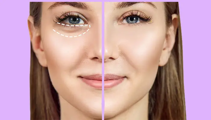 جراحی گودی کاسه چشم