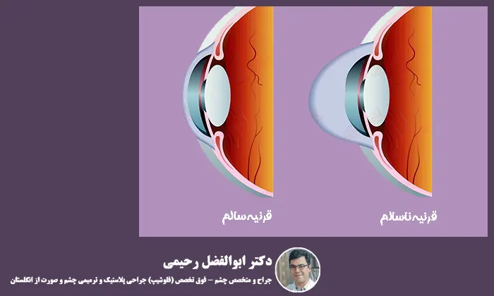 قوز قرنیه