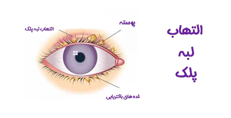 التهاب لبه پلک