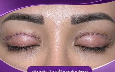 آیا جای بخیه بعد از بلفاروپلاستی باقی می ماند؟ روش های از بین بردن آن