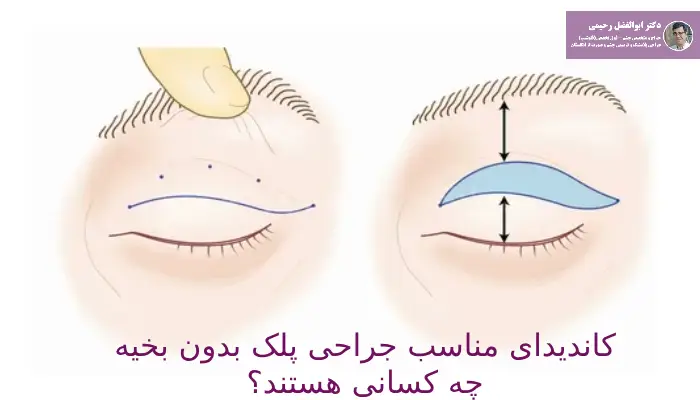 کاندیدای جراحی پلک بدون بخیه