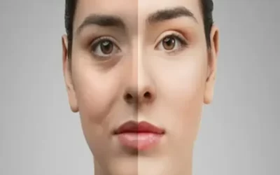 کوچک شدن چشم بعد از بلفاروپلاستی