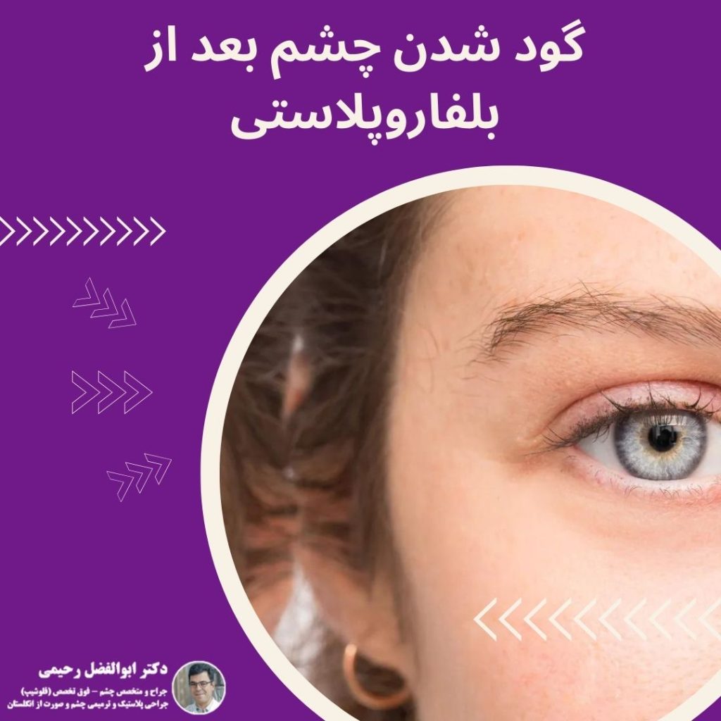 گود شدن چشم بعد از بلفاروپلاستی