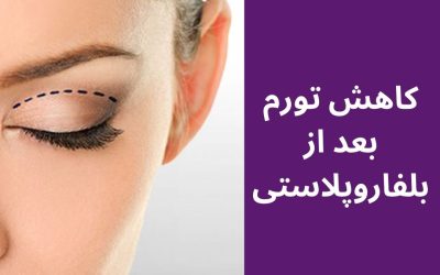 بهترین روش کاهش ورم بعد از بلفاروپلاستی چیست؟