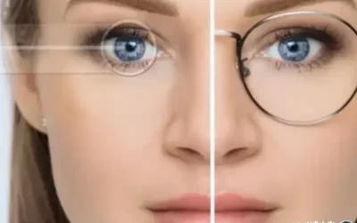 استفاده از لنز قبل از عمل لیزیک؛ نکات مهم