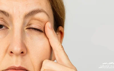 برگشت افتادگی پلک بعد از عمل